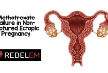 Methotrexate for ectopic pregnancy