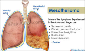 Mesothelioma Survival Rate